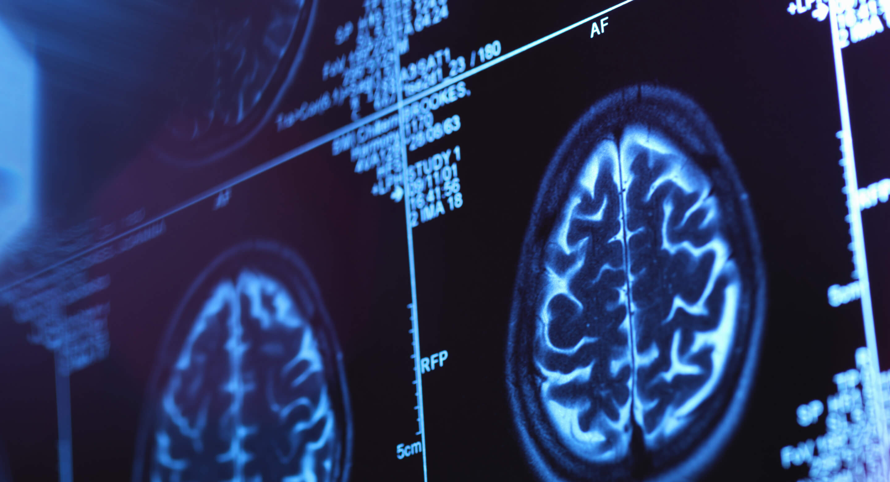 Brain scan